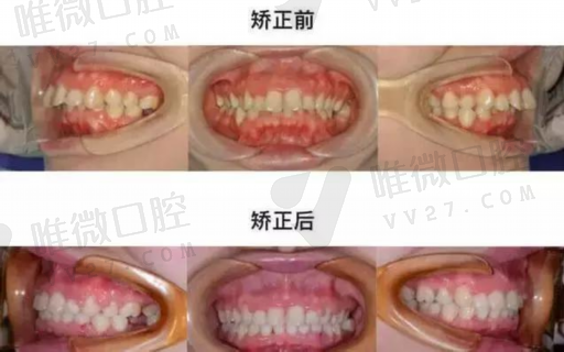牙齿矫正怎样的好处（牙齿矫正的优点）(图1)